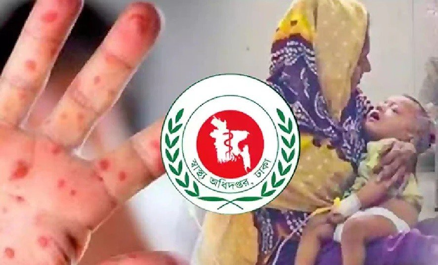 Five More Children Die with Measles Symptoms